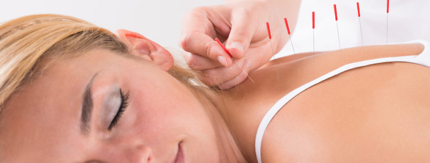 woman getting acupuncture in back